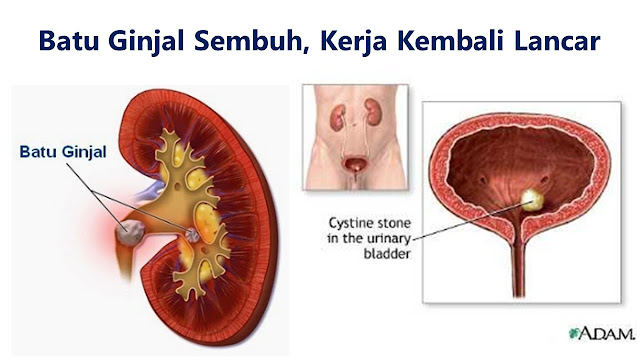 Pencegahan Penyakit Batu Ginjal