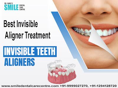 Best Invisible Aligner Treatment in Faridabad