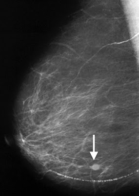 KODING K.N.: Mamogram Atau Ultrasound Mengesan Kanser Payudara