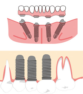 dental implant reading