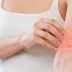 Natural Treatments for Severe Eczema