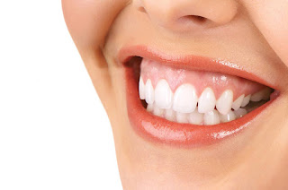 Răng vàng có tẩy trắng được không-3