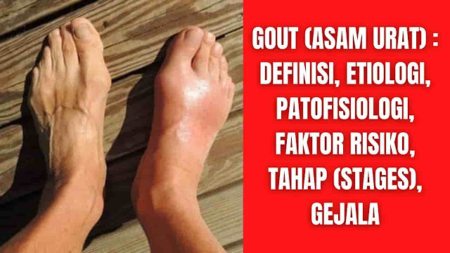 Gout (Asam Urat) : Definisi, Etiologi, Patofisiologi, Faktor Risiko, Tahap (Stages), Gejala Definisi Asam urat (Gout) adalah gangguan metabolisme yang menyebabkan peradangan pada persendian. Selama episode akut, sendi tertentu membengkak hanya dalam beberapa jam dan menjadi sangat sensitif terhadap rasa sakit. Peradangan dipicu oleh kristal asam urat berbentuk jarum kecil yang terutama menumpuk di persendian. Kristal ini dapat terbentuk jika ada terlalu banyak asam urat dalam tubuh. Peradangan biasanya hilang dengan sendirinya dalam satu hingga dua minggu. Rasa sakitnya bisa dihilangkan dengan obat-obatan.  Kebanyakan orang dengan asam urat mengalami serangan akut sesekali. Berbulan-bulan atau bahkan bertahun-tahun dapat berlalu di antara serangan, tetapi mungkin juga lebih sering. Ada beberapa opsi untuk mencegahnya. Beberapa orang sudah melihat peningkatan jika mereka menghindari makanan tertentu dan kemungkinan pemicu lainnya. Orang lain mungkin minum obat untuk menurunkan kadar asam urat mereka dalam jangka panjang. Obat ini sebagian besar dipertimbangkan untuk orang yang sering mengalami serangan asam urat atau komplikasi seperti batu ginjal atau benjolan yang disebut tophi.  Banyak orang memiliki kadar asam urat yang tinggi tanpa menyebabkan masalah yang nyata. Tidak jelas apakah ini mempengaruhi kesehatan mereka. Itu tidak perlu dirawat.    Etiologi Kekuatan pendorong di balik episode akut gout adalah hiperurisemia (didefinisikan sebagai peningkatan asam urat serum (lebih tepatnya disebut sebagai serum urat, untuk bentuk garam dari asam urat yang terjadi dalam serum) konsentrasi lebih besar dari 6,8 mg per desiliter [dl] pada pria dan lebih besar dari 6,0 pada wanita). Hiperurisemia paling sering merupakan hasil dari ekskresi asam urat ginjal yang tidak memadai atau, lebih jarang, produksi asam urat yang berlebihan (asam urat adalah produk pemecahan makanan atau purin endogen). Hiperurisemia menyebabkan pembentukan dan pengendapan kristal MSU, yang lebih disukai disimpan di sendi, tendon, dan ruang bursa. Terlepas dari prevalensi hiperurisemia, untuk alasan yang masih belum jelas, hanya sebagian kecil individu dengan hiperurisemia yang berkembang menjadi asam urat. Bagi yang lain, hiperurisemia tetap asimtomatik. Prevalensi hiperurisemia berkisar antara 21,2 persen pada pria hingga 21,6 persen pada wanita, empat hingga sepuluh kali lipat lebih tinggi daripada prevalensi asam urat.  Penyebab asam urat bersifat multifaktorial, antara lain kombinasi genetik, hormonal, metabolik, farmakologis, komorbiditas (penyakit ginjal), dan faktor diet. Riwayat keluarga, usia lanjut, jenis kelamin pria, atau, pada wanita, menopause dini telah dikaitkan dengan risiko gout dan/atau gout flare yang lebih tinggi. Faktor risiko makanan untuk asam urat termasuk konsumsi makanan atau minuman yang kaya purin, termasuk daging, dan makanan laut; dan konsumsi minuman bersoda manis, alkohol, dan makanan tinggi fruktosa. Makanan susu dan kopi telah dikaitkan dengan risiko kejadian asam urat yang lebih rendah dan dalam beberapa kasus tingkat serangan asam urat yang lebih rendah. Namun, peran diet dalam etiologi dan pengobatan asam urat adalah topik penelitian yang cukup besar dan akan ditinjau dalam tinjauan sistematis yang terpisah.    Patofisiologi Asam urat mengacu pada penyakit yang terjadi sebagai respons terhadap keberadaan kristal MSU di persendian, jaringan lunak, dan tulang. Ini dapat menyebabkan gout flare (arthritis akut), arthritis gout kronis (arthritis kronis), atau gout tophaceous (tophi).  Berikut ini adalah sejumlah proses kompleks dan saling berinteraksi yang bertanggung jawab atas patofisiologi gout:  Genetik, metabolik, dan faktor lain yang menyebabkan hiperurisemia Metabolik, fisiologis, dan karakteristik lain yang bertanggung jawab untuk pembentukan kristal MSU. Proses inflamasi, seluler, dan imun bawaan yang larut serta karakteristik kristal MSU sendiri mendorong respons inflamasi akut. Mekanisme kekebalan yang memediasi resolusi peradangan akut yang diinduksi kristal MSU akut Proses inflamasi kronis dan efek sel imun dan kristal pada osteoblas, kondrosit, dan osteoklas berkontribusi pada atrisi tulang rawan, erosi tulang, cedera sendi, dan pembentukan tofi.   Hiperurisemia Hiperurisemia adalah faktor kunci untuk perkembangan gout karena dapat meningkatkan nukleasi kristal monosodium urat dan pertumbuhan dengan mengurangi kelarutan urat. Asam urat dalam darah berasal dari pemecahan purin eksogen dan endogen, yang dikeluarkan melalui ginjal. Kelebihan produksi dan/atau ekskresi asam urat adalah dasar untuk peningkatan kadar asam urat serum.  Kristal Kelarutan MSU ditentukan oleh konsentrasinya dan faktor-faktor yang mempengaruhi nukleasi dan pertumbuhan kristal. Kelarutan MSU turun dengan cepat dengan penurunan suhu.  Respon Inflamasi Peradangan dimulai ketika makrofag memfagosit kristal monosodium urat dan memicu pembentukan dan aktivasi kompleks protein sitosolik (NLRP2 inflammasome). Kompleks ini kemudian merekrut caspase-1, yang mengaktifkan pro-IL-1beta menjadi IL-1beta. IL-1beta memainkan peran penting dalam respon inflamasi gout. Ini mempromosikan vasodilatasi, perekrutan monosit dan memulai dan memperkuat kaskade inflamasi. Sekresi IL-1beta lebih lanjut dapat menyebabkan kerusakan tulang dan kartilago. Sitokin lain, seperti TNF-1, IL-6, CXCL8, dan COX-2, juga terlibat dalam respon inflamasi.  Tofi (Tophi) adalah endapan kristal MSU yang meliputi peradangan granulomatosa. Tophus adalah respon inflamasi kronis yang dinamis terhadap deposisi kristal MSU yang kompleks dan terorganisir. Tofi paling sering ditemukan di daerah periartikular, artikular, dan subkutan, termasuk tulang rawan, tulang, sendi, tendon, dan kulit, yang kaya akan proteoglikan. Reaksi jaringan terhadap tophus umumnya merupakan peradangan kronis dan melibatkan imunitas adaptif dan bawaan. Beberapa pasien dengan gout tophaceous juga hadir dengan artritis gout kronis (sinovitis kronis). Ada hubungan erat antara deposit kristal MSU dan perkembangan tulang rawan dan erosi tulang. Tophi berkontribusi terhadap kerusakan sendi dan erosi tulang pada asam urat. Deposit kristal MSU dikelilingi oleh sel-sel mirip osteoklas pada antarmuka tulang dan tophus.    Faktor Risiko Apa pun yang meningkatkan kadar asam urat juga dapat meningkatkan risiko asam urat. Orang yang pernah mengalami serangan asam urat memiliki risiko lebih besar untuk mengalami lebih banyak serangan. Hal-hal berikut ini telah terbukti secara ilmiah sebagai faktor risiko penyakit asam urat:  Obat-obatan yang meningkatkan kadar asam urat : Ini termasuk diuretik dan asam asetilsalisilat (obat dalam obat-obatan seperti Aspirin), serta obat-obatan khusus yang diminum setelah transplantasi organ. Levodopa, pengobatan Parkinson, dan obat kanker juga dapat meningkatkan risiko asam urat. Daging, ikan dan makanan laut : Makanan ini mengandung banyak purin. Jika mereka dimakan dalam jumlah besar, mereka sedikit meningkatkan risiko asam urat. Beberapa makanan nabati juga kaya purin, tetapi penelitian belum menemukan bukti bahwa mereka mempengaruhi perkembangan asam urat. Alkohol : Minuman beralkohol meningkatkan produksi asam urat dan memiliki efek diuretik. Alkohol juga menyebabkan ginjal melepaskan lebih sedikit asam urat. Bir khususnya mengandung jumlah purin yang relatif tinggi juga. Penelitian telah menunjukkan bahwa bir dan alkohol tahan tinggi dapat meningkatkan risiko asam urat. Anggur (dalam jumlah sedang) tampaknya tidak berpengaruh. Minuman manis : Minuman yang banyak mengandung gula (fruktosa) juga sedikit meningkatkan risiko asam urat. Hal ini berlaku baik untuk minuman manis seperti cola maupun jus buah. Minuman ringan yang mengandung pemanis, bukan gula, tidak dikaitkan dengan asam urat. Kelebihan berat badan : Kelebihan berat badan – dan memiliki indeks massa tubuh yang lebih tinggi – meningkatkan risiko asam urat.  Bahkan jika makanan tertentu dan faktor lain mungkin sedikit meningkatkan risiko asam urat atau serangan asam urat, lebih penting bahwa ginjal bekerja dengan baik dan secara konsisten mampu mengurangi kadar asam urat yang tinggi.    Tahap Gout (Stages Of Gout) Hiperurisemia asimtomatik merupakan tahap awal gout dan banyak pasien hiperurisemia tidak pernah mengalami manifestasi klinis gout.  Gout akut biasanya muncul sebagai onset mendadak dari sendi eritematosa, hangat, bengkak, dan sangat sensitif, klasik sendi metatarsophalangeal pertama. Curigai gout jika pasien memiliki onset akut nyeri sendi monoartikular dengan intensitas maksimum yang terjadi dalam 12 jam. Dalam beberapa kasus, gout akut mungkin sembuh sendiri.  Gout interkritis atau interval terjadi setelah gejala akut telah teratasi, dan peradangan tingkat rendah dapat tetap berada di dalam sendi, menyebabkan kerusakan yang tidak diketahui. Selama tahap interkritis ini, hiperurisemia persisten mendorong deposisi dan agregasi kristal monosodium urat ke dalam perkembangan tofi, menyebabkan perubahan erosif pada tulang, yang dapat terlihat secara radiografi pada pasien dengan gout kronis.  Gout kronis adalah artralgia persisten atau episode berulang dari gout akut, biasanya disertai dengan pembentukan tofi. Meskipun kerangka waktu untuk pengembangan tophi bervariasi di seluruh penelitian, tanpa terapi penurun urat, sekitar 30% pasien mengalami gout kronis dalam waktu 5 tahun. Gejala asam urat akut seringkali tidak dikenali dengan baik pada pasien dengan asam urat kronis karena kurangnya intensitas atau pembengkakan jaringan lunak; dalam kasus ini, presentasi pasien mungkin hanya meniru osteoartritis.    Gejala (Symptoms) Serangan asam urat sering dimulai pada malam hari atau dini hari dengan pembengkakan sendi yang tiba-tiba dan sangat menyakitkan. Sendi yang meradang sensitif terhadap tekanan, dan menjadi terlalu panas dan merah. Pembengkakan dan gejala lainnya biasanya paling buruk setelah enam hingga dua belas jam. Sendi sering menjadi sangat sensitif sehingga bahkan berat selimut tebal pun tidak tertahankan. Ketika pembengkakan berkurang setelah beberapa hari, kulit di sekitar sendi mungkin mulai mengelupas.  Serangan asam urat awal seringkali hanya mempengaruhi satu sendi, biasanya pangkal jempol kaki. Sendi kaki bagian tengah dan pergelangan kaki, lutut, siku, pergelangan tangan dan buku-buku jari juga bisa meradang. Serangan asam urat sangat jarang terjadi di bahu atau pinggul. Jika asam urat kronis, persendian akan tetap sedikit meradang sepanjang waktu. Mereka mungkin menjadi cacat dalam jangka panjang, membuatnya lebih sulit untuk dipindahkan.