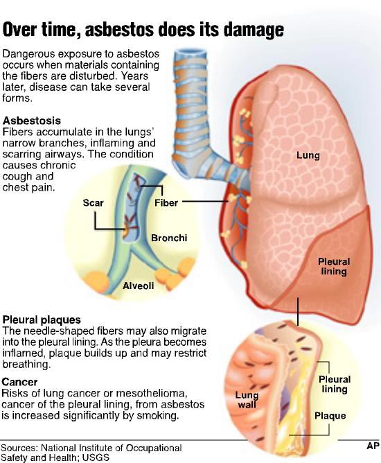 Mesothelioma: What is Asbestosis