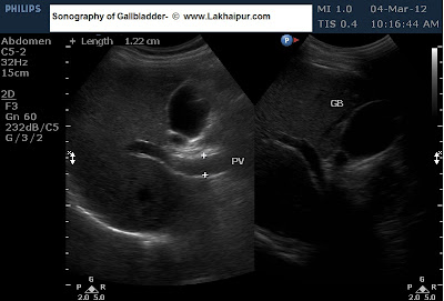 gallstone sonography