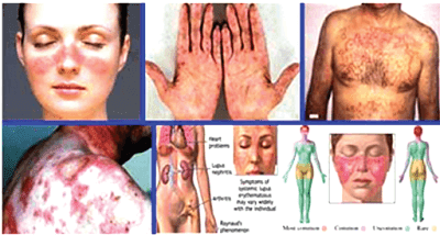 Gejala AIDS yang timbul seperti :    1. Radang paru, saluran pencernaan, dan radang yang disebabkan jamur di mulut dan kerongkongan.  2. Kanker kulit.  3. TBC.  4. Gangguan susunan saraf.