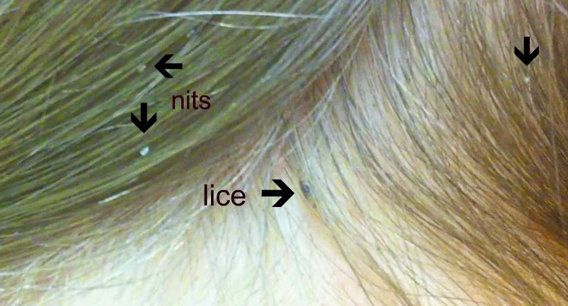 How to kill Head Lice