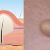 Sebaceous Cysts: Causes, Symptoms, Diagnosis, Prevention and Treatments