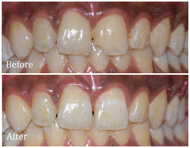 Composite Filling for Fractured Tooth