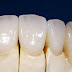 Những loại răng sứ thẩm mỹ