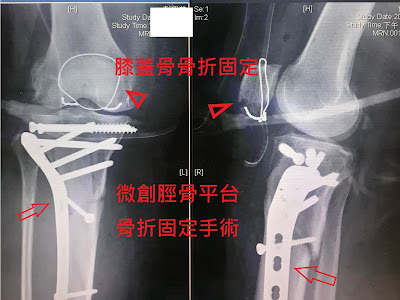 画像 脛骨 骨折 手術 184600-脛骨 骨折 手術 プレート