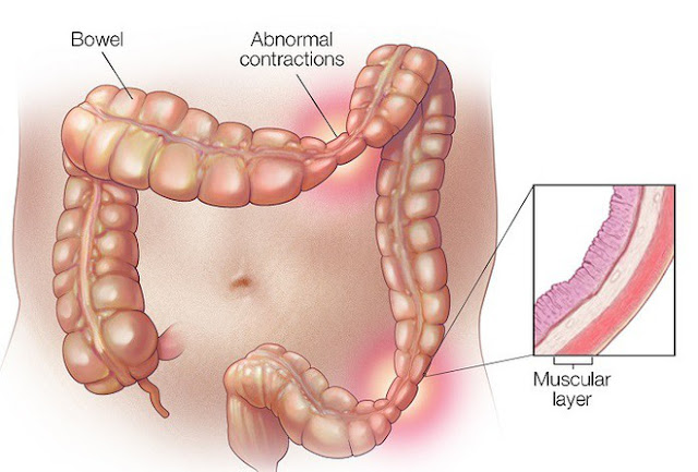 bệnh viêm đại tràng co thắt