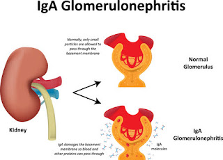 glomerulonephritis treatment in Ayurveda