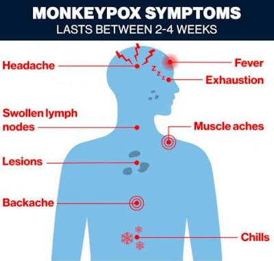 symptoms-monkeypox-treat