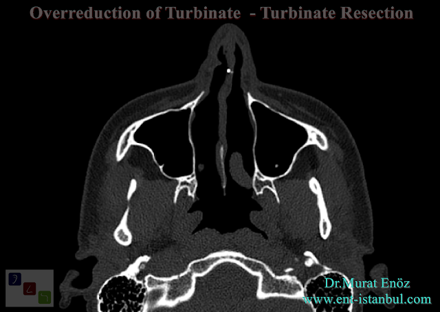 Overreduction of Turbinate,Turbinate Resection,Nasal Hyperventilation,Limited Turbinate Radifrequency,Normal turbinate volume, Sensation of being unable to breathe
