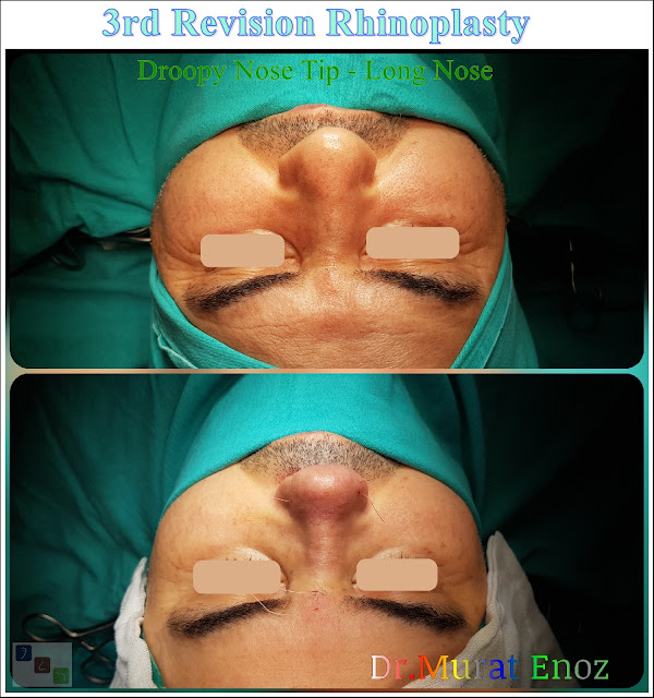 3rd Revision Rhinoplasty - Droopy Nose Tip - Tertiary Nose Job For Men