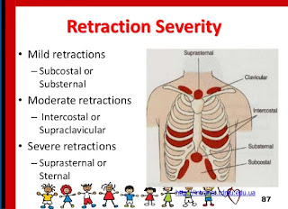   intercostal retractions, intercostal retractions ards, intercostal retractions treatment, intercostal recession definition, intercostal retractions causes, substernal retraction, intercostal retractions newborn, intercostal retractions in adults, intercostal retractions toddler