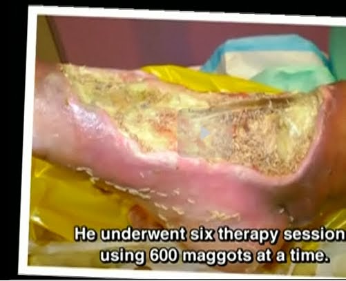 Maggot Treatment Help Heal Diabetic Wound Maggot Treatment Help Heal Diabetic Wound