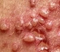  Herpes yakni suatu penyakit pada kulit badan yg diakibatkan serangan virus herpes 8 Jenis Penyakit Herpes (Penyebab, Gejala & Pengobatannya)