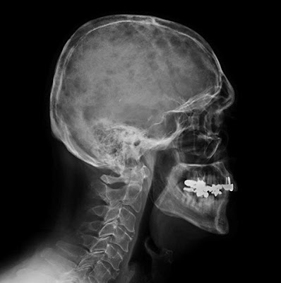 Characteristic osteolytic lesions in the skull of a patient with myeloma