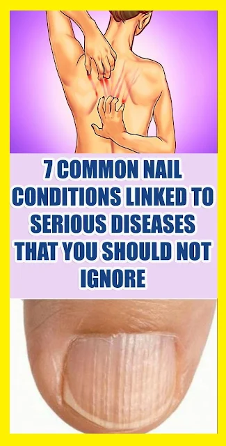 7 Common Nail Conditions Linked To Serious Diseases That You Should Not Ignore