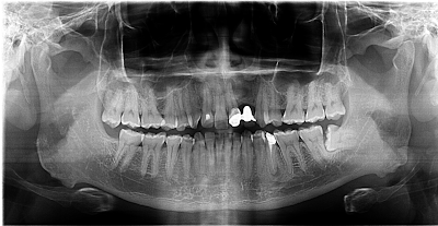 Panoramik Gigi Impaksi