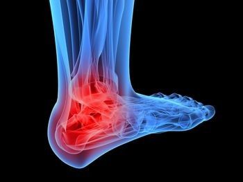 Are suffering for Bone Spurs?Try Home Remedies.