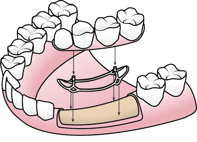 Quali sono i tipi di impianti dentali che vengono utilizzati oggi nel mondo e in Albania impianto sottoperiostei posizionato sull'osso mascellare sinistro in sostituzione di dente canino, premolari e molari