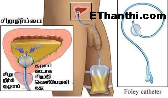 அடிக்கடி கட்டுப்படுத்த முடியாமல் வெளியேறும் சிறுநீர் !