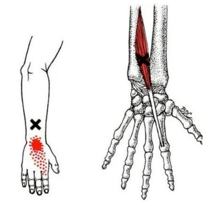 Antebrazo y muñeca - El extensor del índice (Extensor indicis) es un músculo delgado y elongado, localizado en la parte posterior del antebrazo - MCdevservices Spa