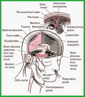 Masa Inkubasi Penyakit Meningitis