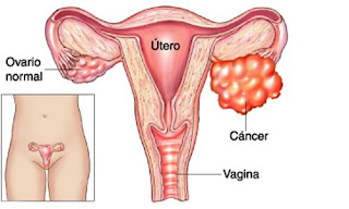 La extirpacion de las trompas de falopio también puede reducir significativamente el riesgo de cáncer de ovario en dos tercios
