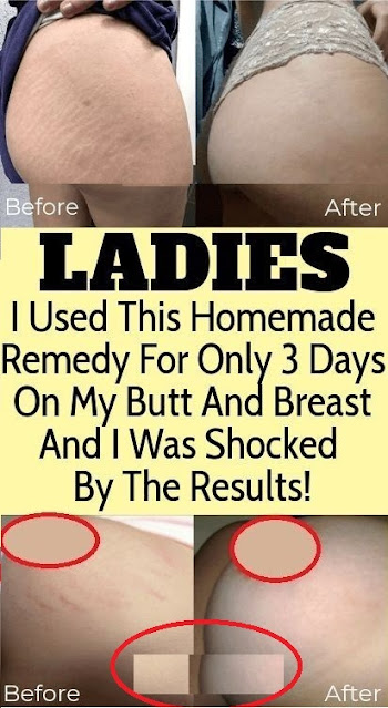 Ladies I Used This Homemade Remedy For Only 3 Days On My Butt And Breast And I Was Shocked Due To The Results!