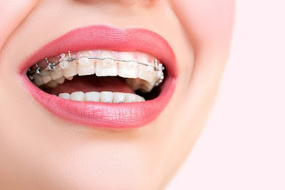 Sức khỏe có ảnh hưởng khi niềng răng?