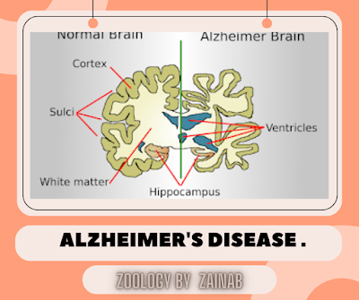 Alzheimer's disease .
