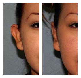 Otoplasty