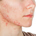 Acne Causes And Tips