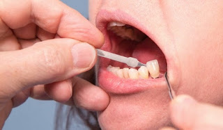 dental-implants-needed