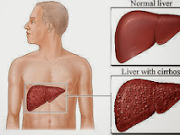 Bahaya Komplikasi Penyakit Sirosis Hati