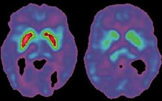 Possible Future Treatment for Parkinson’s Disease?