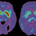 Possible Future Treatment for Parkinson’s Disease?