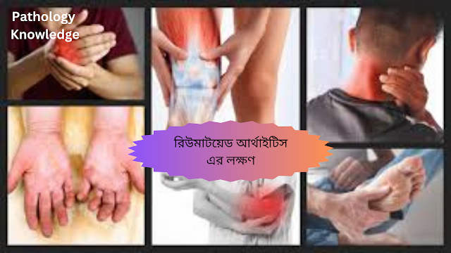 রিউমাটয়েড আর্থাইটিস এর লক্ষণ