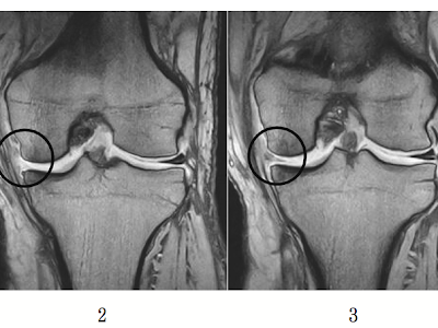 上 内側半月板損傷 mri 347346-内側半月板損傷 mri