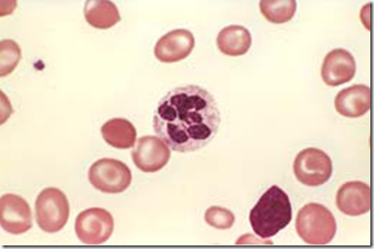 Gambaran preparat darah apus anemia megaloblastik