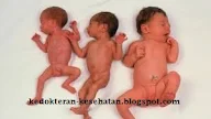 Penanganan Bayi Berat Badan Lahir Rendah (BBLR)
