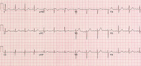 A normal ECG