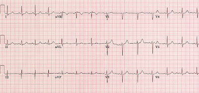 A normal ECG