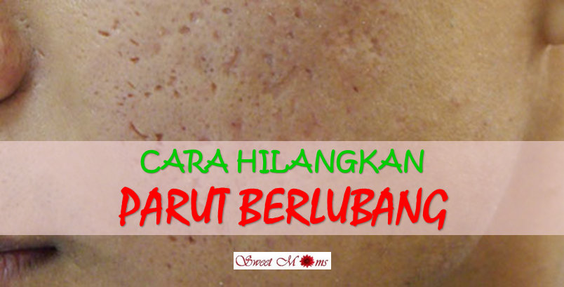 Cara Hilangkan Parut Jerawat Berlubang Dengan Mudah Dan 