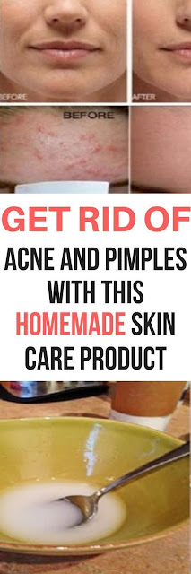 GET RID OF ACNE AND PIMPLES, ALLEVIATE SUNBURN AND IMPROVE COMPLEXION WITH THIS HOMEMADE SKIN CARE PRODUCT!