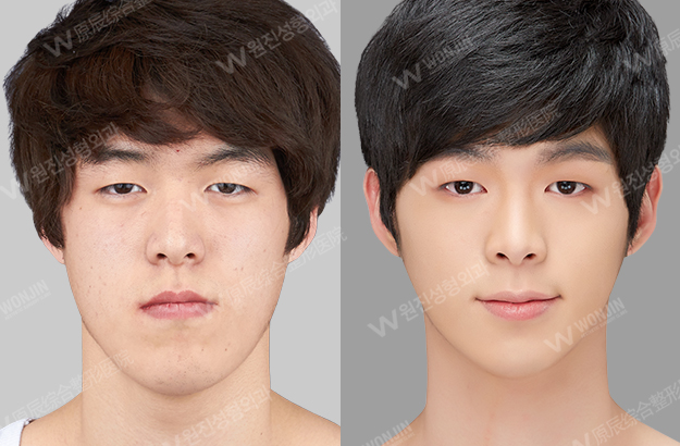 짱이뻐! - Before and After Photos Korean Plastic Surgery for Men